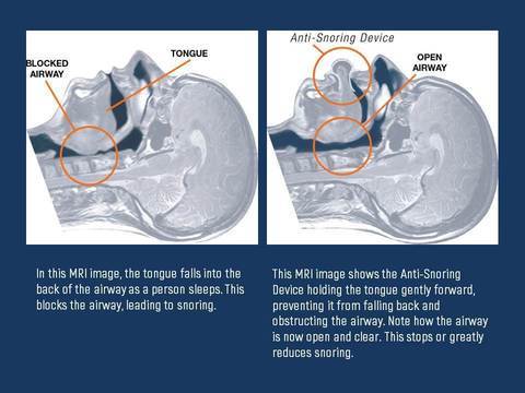 Tongue Stabilizing Device | Medical-Grade Silicone & Denture-Friendly